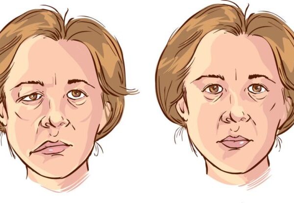 Bells Palsy2